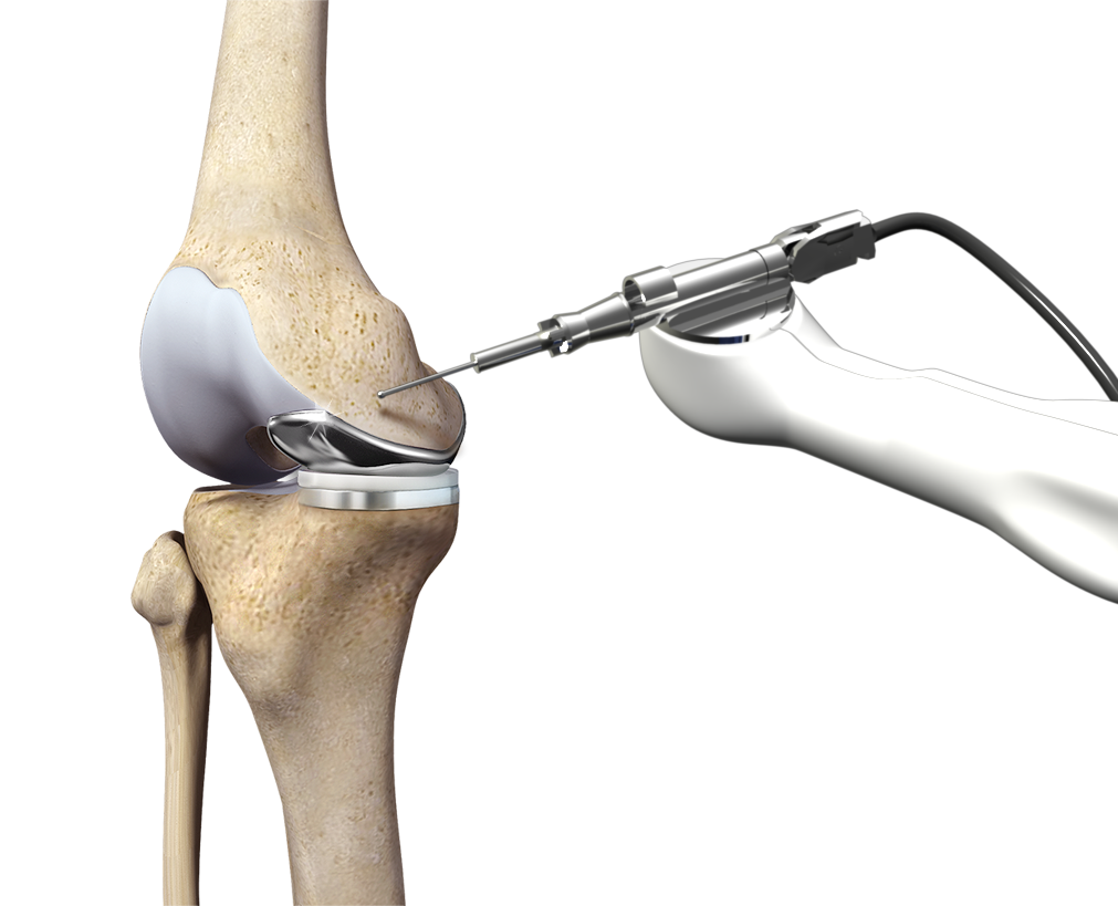 Robotic Assisted Knee Replacement